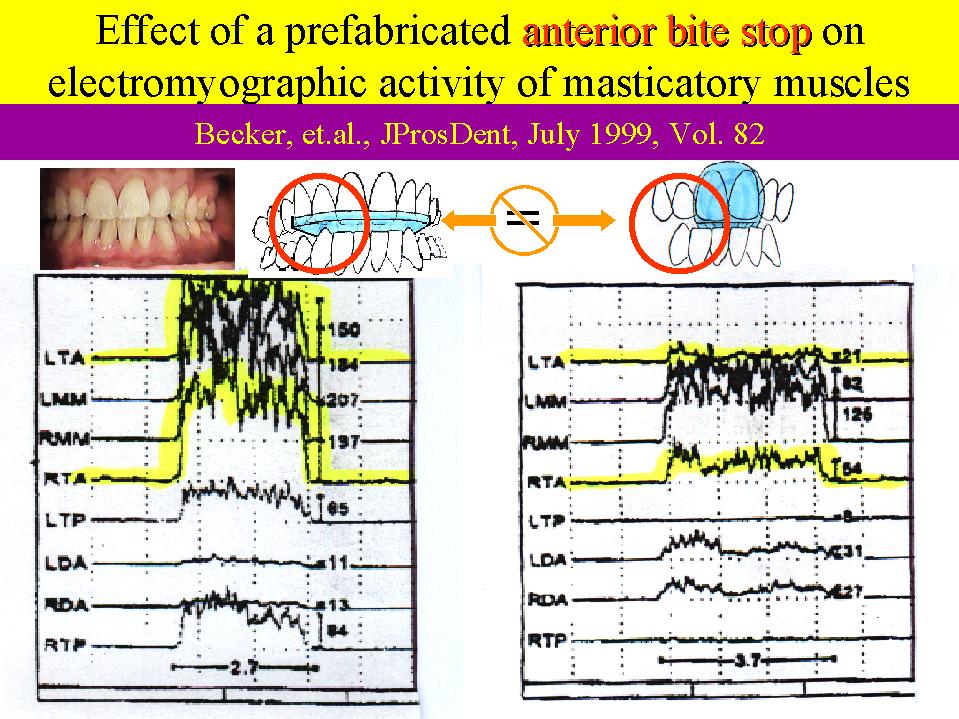 Becker, et al, Effect of a prefabricated anterior bite stop on electromyographic activity of masticatory muscles J Pros Dent, July 1999, Vol. 82